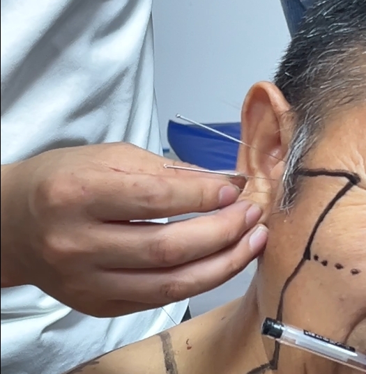 西安针灸班